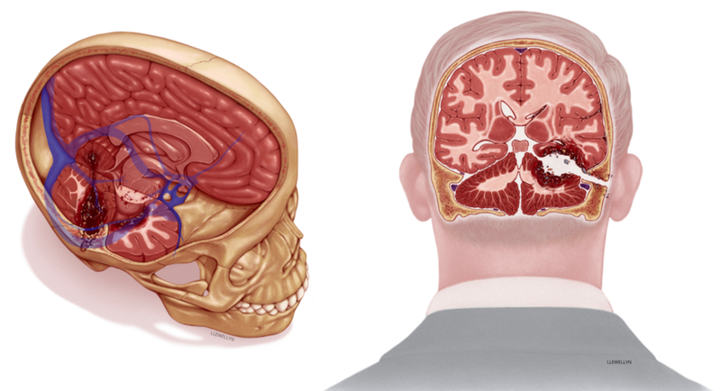 Artist’s depiction of RFK’s injuries.